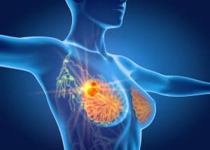 Improper Back Pain Diagnosis Delays Treatment for Stage 4 Breast Cancer